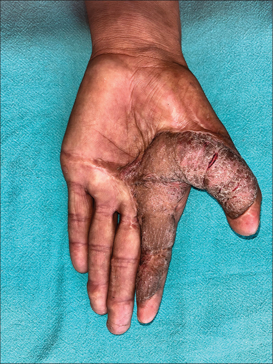 Hyperpigmented skin flap with overlying scaling and fissures localized to skin flap with sharp demarcation line from adjacent normal skin.