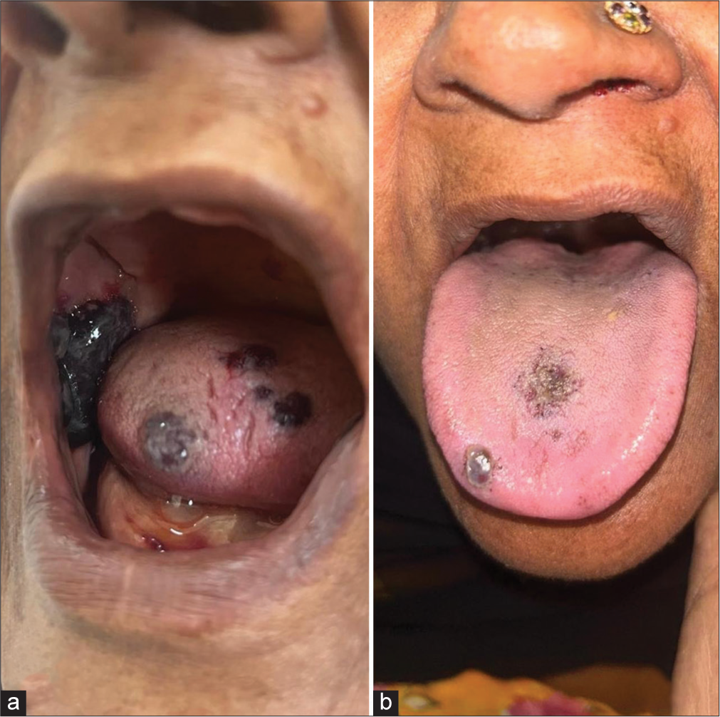 (a) Multiple hemorrhagic bullae over buccal mucosa and dorsum of tongue. (b) The lesions resolved spontaneously within a few days (Case 1).