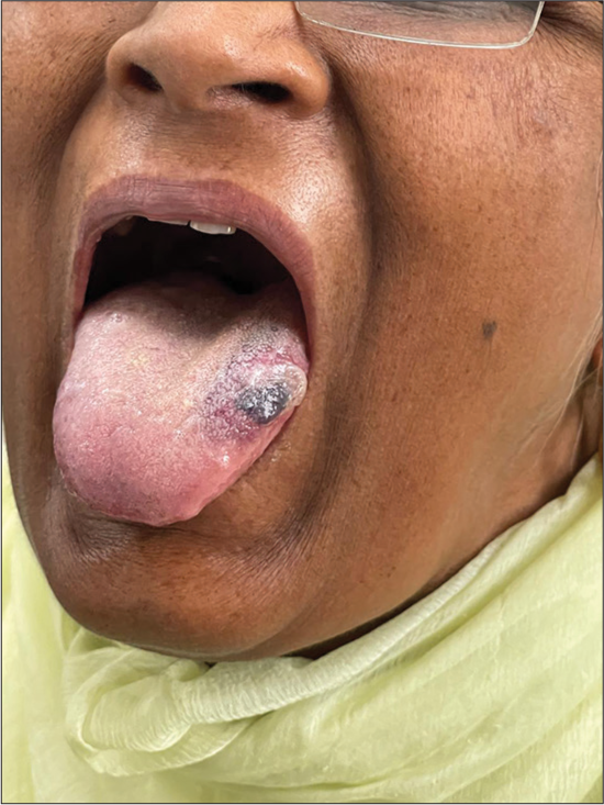 Single hemorrhagic bulla over the left lateral aspect of the tongue (Case 2).