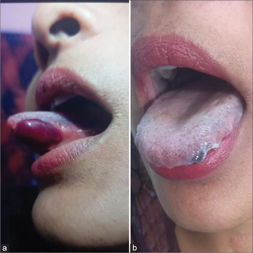 (a) Single, tense hemorrhagic bulla over the left lateral aspect of the tongue. (b) The lesion healed on its own within a few days (Case 3).