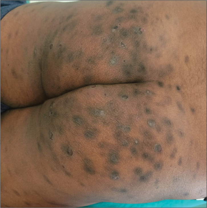 Multiple prurigo nodularis lesions over buttock before treatment.