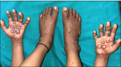 Multiple clear vesicles and tense bullae with erythematous borders, a few crusted papules, and excoriations on the palms, fingers, soles, and dorsae of the feet.