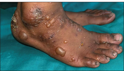 Multiple clear vesicles and tense bullae with erythematous borders, a few crusted papules, and excoriations on the dorsum of the foot.