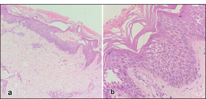 (a) HPE ×10 shows epidermis with moderate orthokeratosis, moderate spongiosis, and intraepidermal vesicle. The basal layer is intact. The upper dermis shows mild infiltrate of lymphocytes and occasional eosinophils around the vessels and adnexae, (b) HPE ×40 shows epidermis with moderate orthokeratosis, moderate spongiosis, and intraepidermal vesicle. The basal layer is intact. The upper dermis shows mild infiltrate of lymphocytes and occasional eosinophils around the vessels and adnexae. HPE: Histopathological examination.