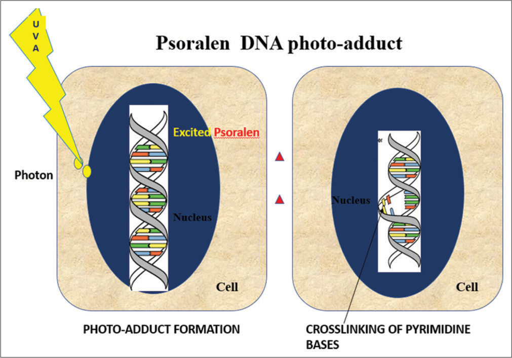 Process of formation of photo adducts with psoralen as a chromophore. DNA: Deoxyribonucleic acid, UVA: Ultraviolet A.