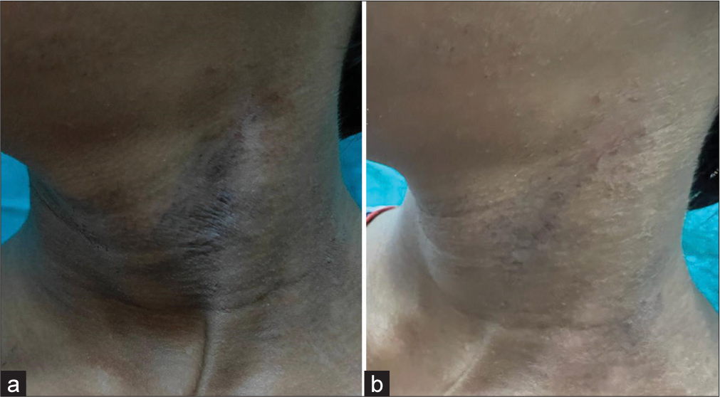 (a and b) It shows the change in atopic dermatitis lesion before and after treatment with crisaborole ointment.