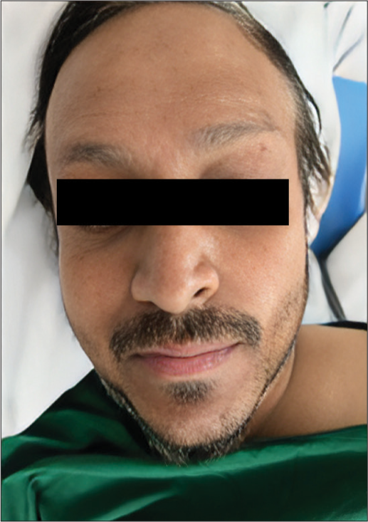 Patient with hair color changes (depigmentation) on treatment with pazopanib.