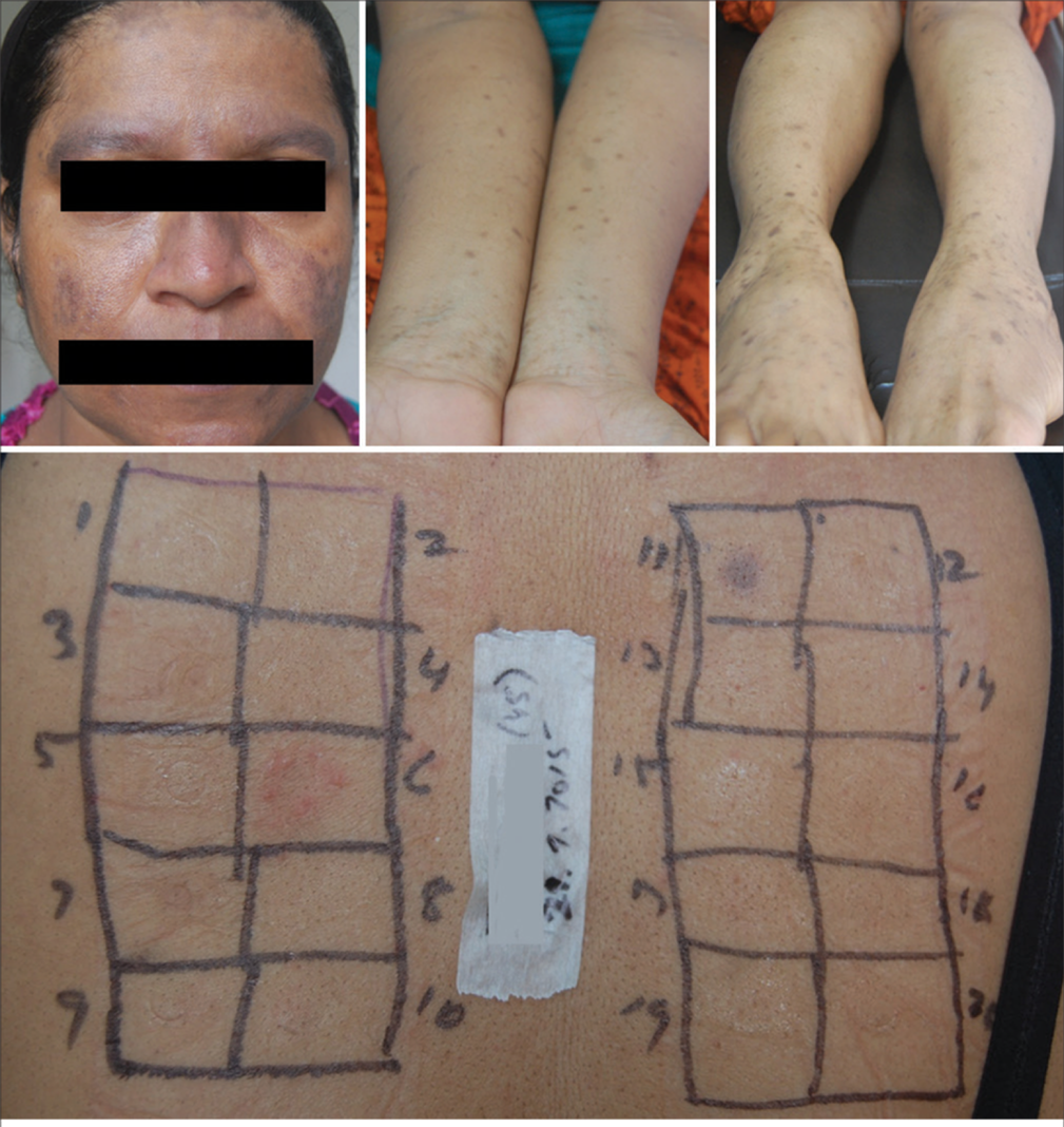 Lichen planus pigmentosus showing positive test for nickel.