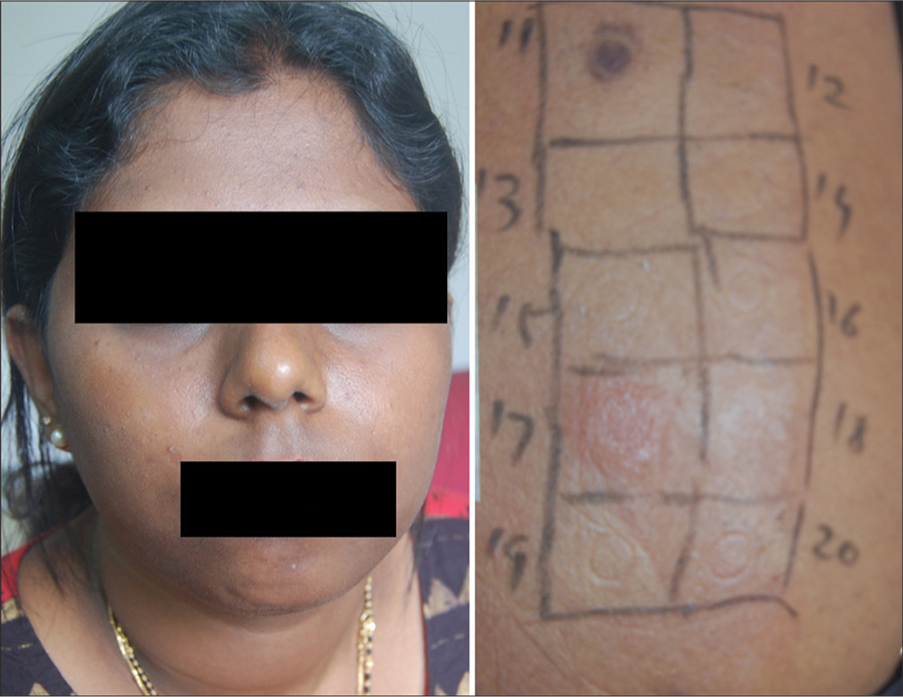 Pigmented contact dermatitis (facial melanosis) showing positive test for fragrance.