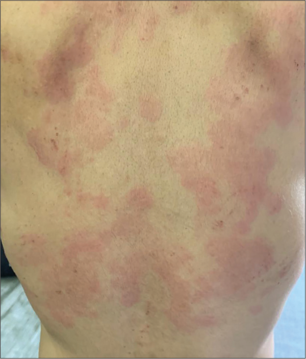 Urticarial lesions over the back during acute flare up.