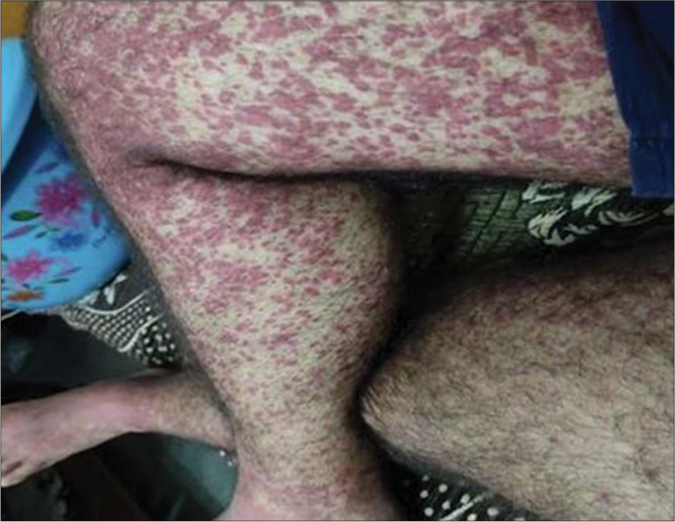 Palpable extensive erythematous maculopapular purpura (1–5) mm in diameter which further coalesced into plaques involving the lower trunk, forearm, and thighs.