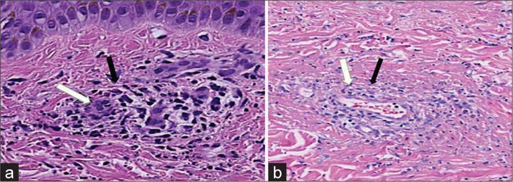 (a and b) the microscopic high-power view of punch biopsy from two distal sites shows infiltration of the lymphocytes and neutrophils around and in superficial vessel walls, swollen vascular endothelium (arrow white), and extravasated erythrocytes (arrow black).