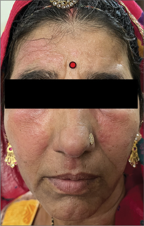 Radiocontrast media induced immediate hypersensitivity reaction with severe angioedema.