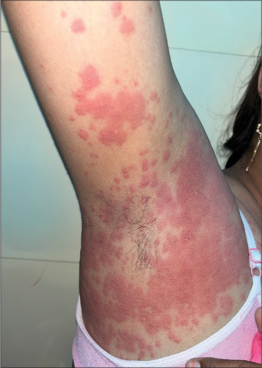 Radiocontrast media induced delayed hypersensitivity reaction with localized erythema multiforme-like eruptions.