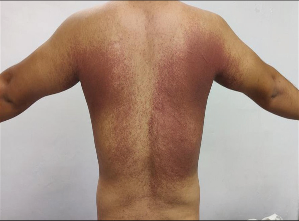 Symmetrical maculopapular erythematous rash over bilateral (B/L) axilla, upper back, and flanks.