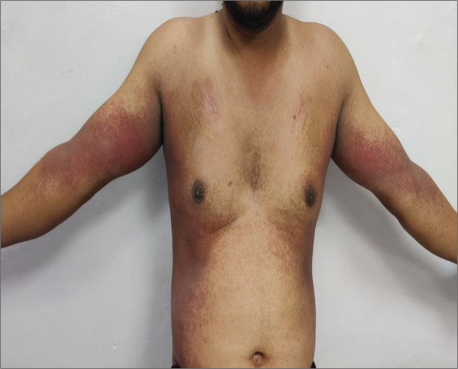 Symmetrical maculopapular erythematous rash over bilateral (B/L) cubital fossae, arms, and axilla.