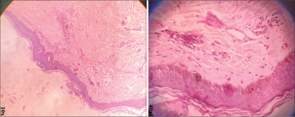 Hematoxylin and eosin (H&E) stained section (× 10 and × 40) showing spongiosis, superficial perivascular inflammatory infiltrate composed mostly of lymphocytes and occasional neutrophils, papillary dermal edema with sparse intraepidermal eosinophils and incontinence of black pigment granules.