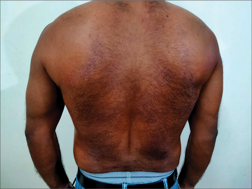 Diffuse erythema & and scaling in a patterned distribution on the convex surface of the back, sparing the midline & and upper back laterally towards the shoulder, coinciding with the area of contact with the car seat.