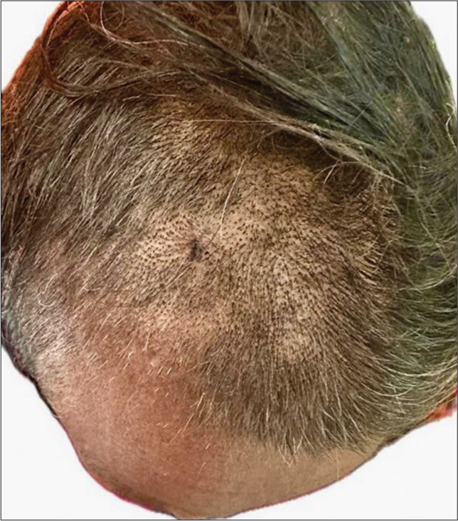 Superior view of the scalp showing the alopecic patch that developed after the resolution of grouped vesicular lesions.