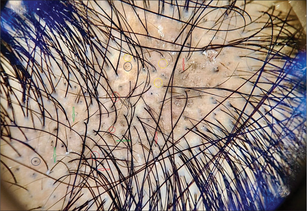 Dermoscopic examination showing black dots (black circle), broken hairs (red arrow), bent hairs (red circle), empty follicles (yellow circles), re-growing hairs (green arrow), and scaling (DermLite DL4; ×10:Polarized).