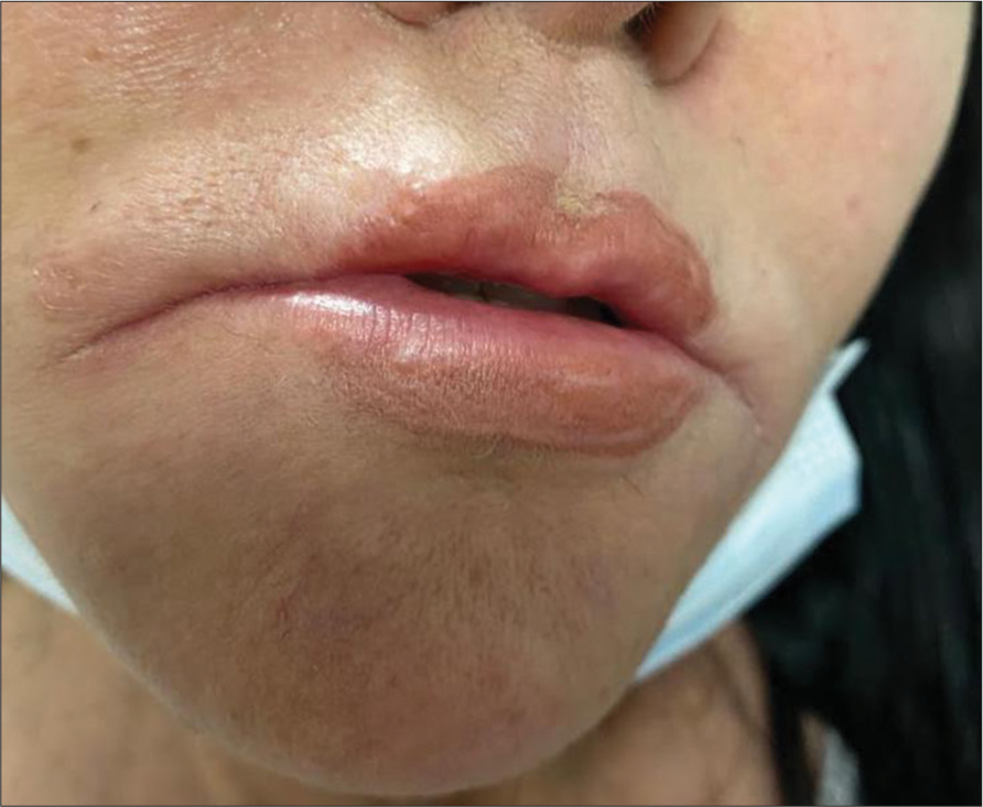 Indurated lips along with erythema after self-injection of sunflower oil.