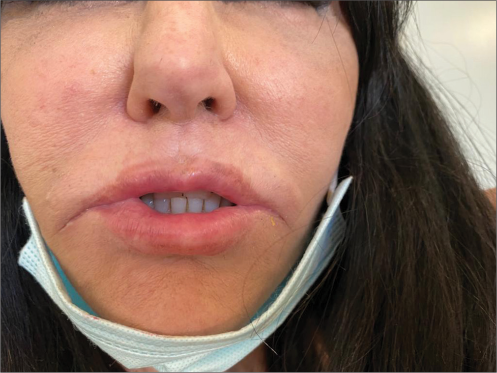 Prominent lip induration and erythema after second injection of sunflower oil into her lips.