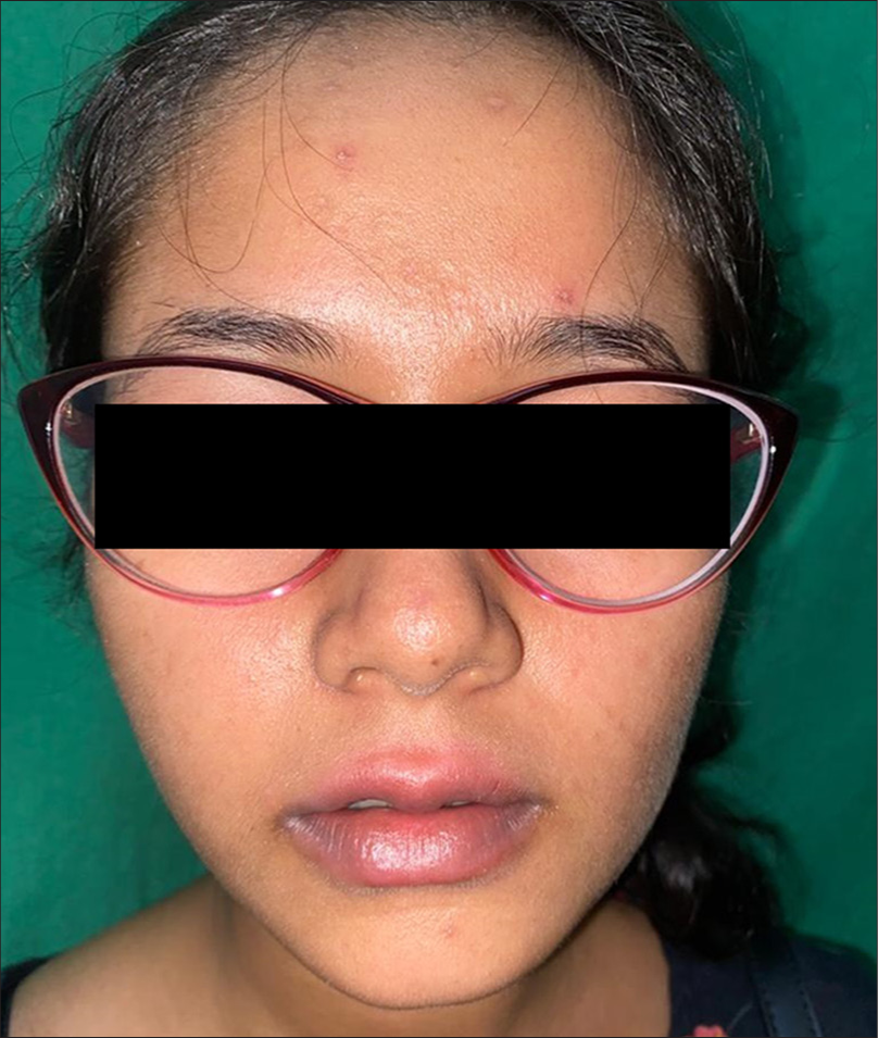 Erythematous scaly plaques over lips and perioral areas of a 12-year-old female patient.