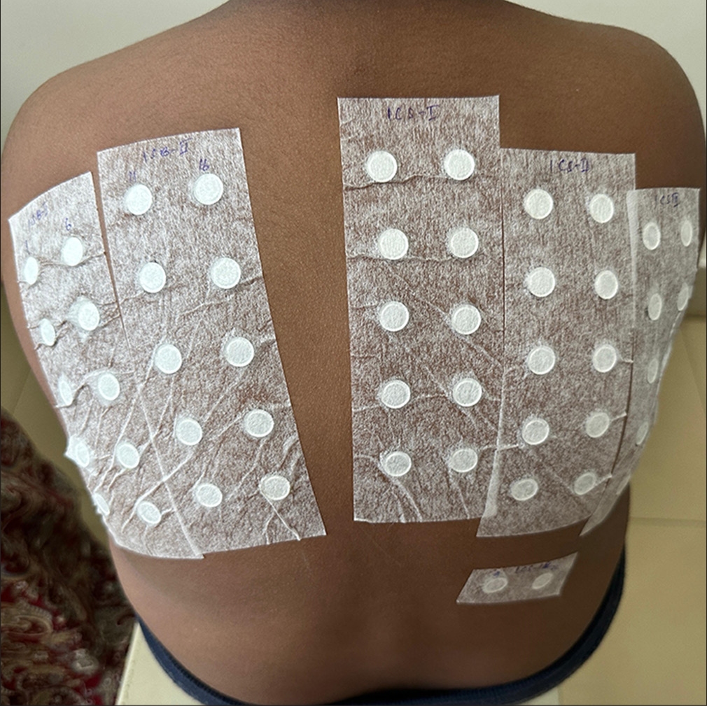 Patch test performed with Indian standard series and cosmetic series over upper back.