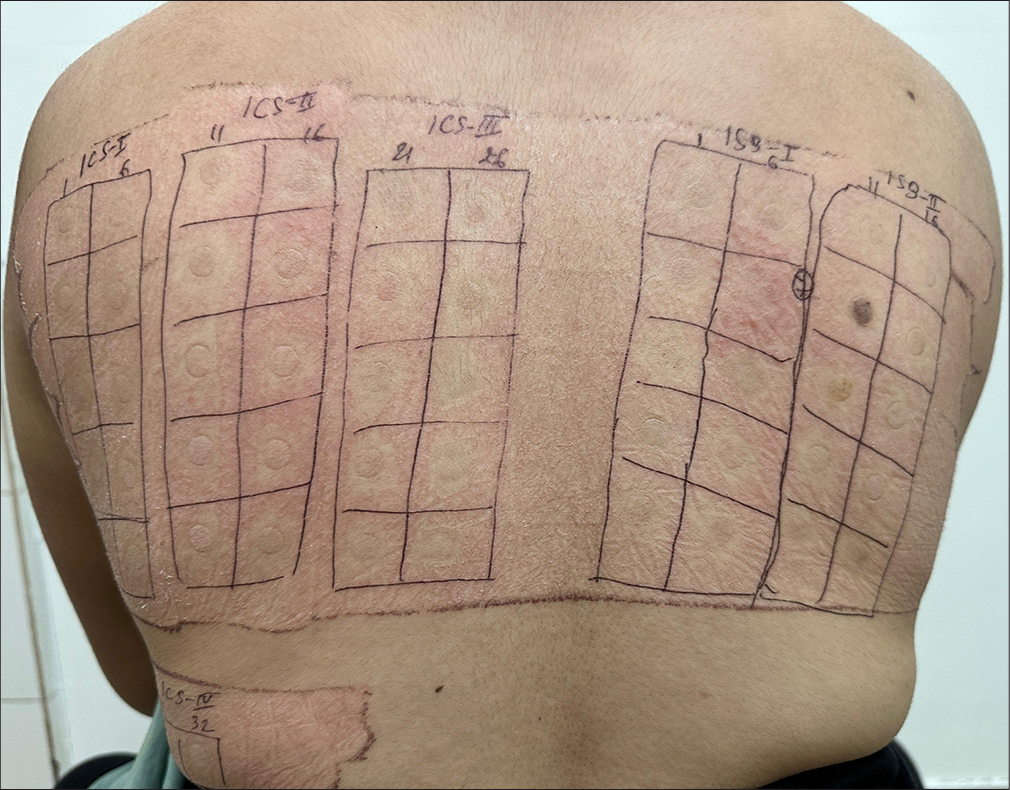 Patch test showing positive test for nickel sulfate (Indian standard series-7).