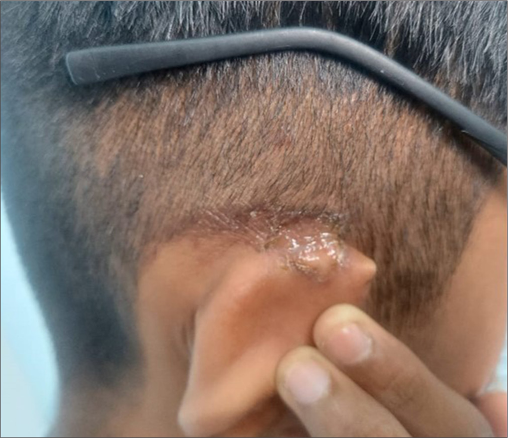 18-year-old boy with oozing and crusting bilaterally over the area of the ear located between the pinna and the temple which corresponds to the area in contact with the temple of the spectacle.