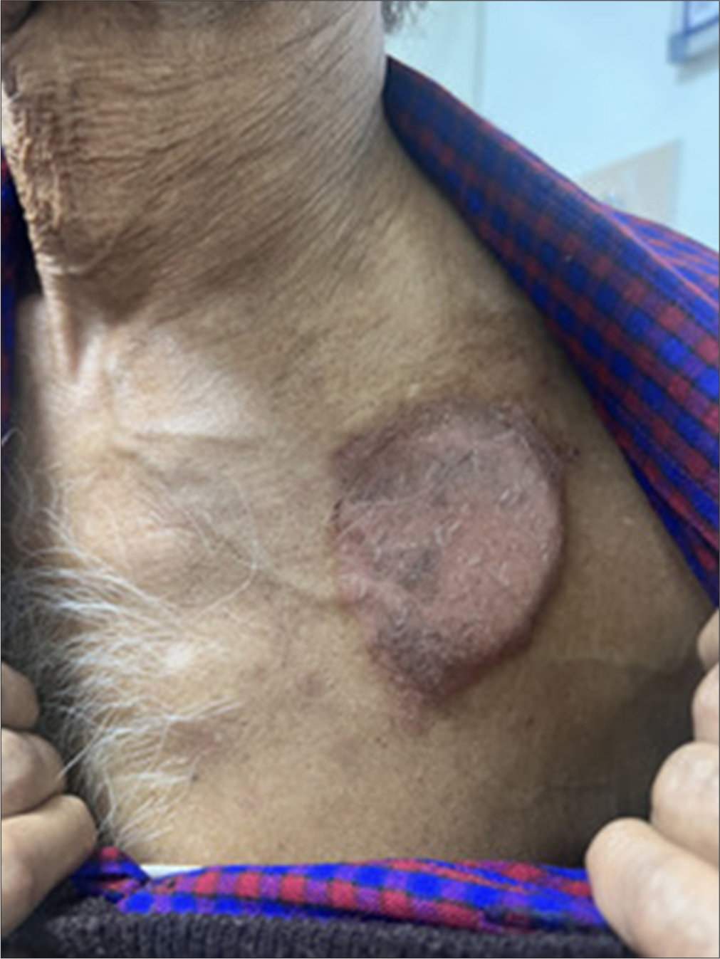 Circumscribed area of dermatitis overlying the area where the cardiac pacemaker – (Dual chamber rate modulated – 3.0T) composed of titanium, chromium, and nickel – was installed.