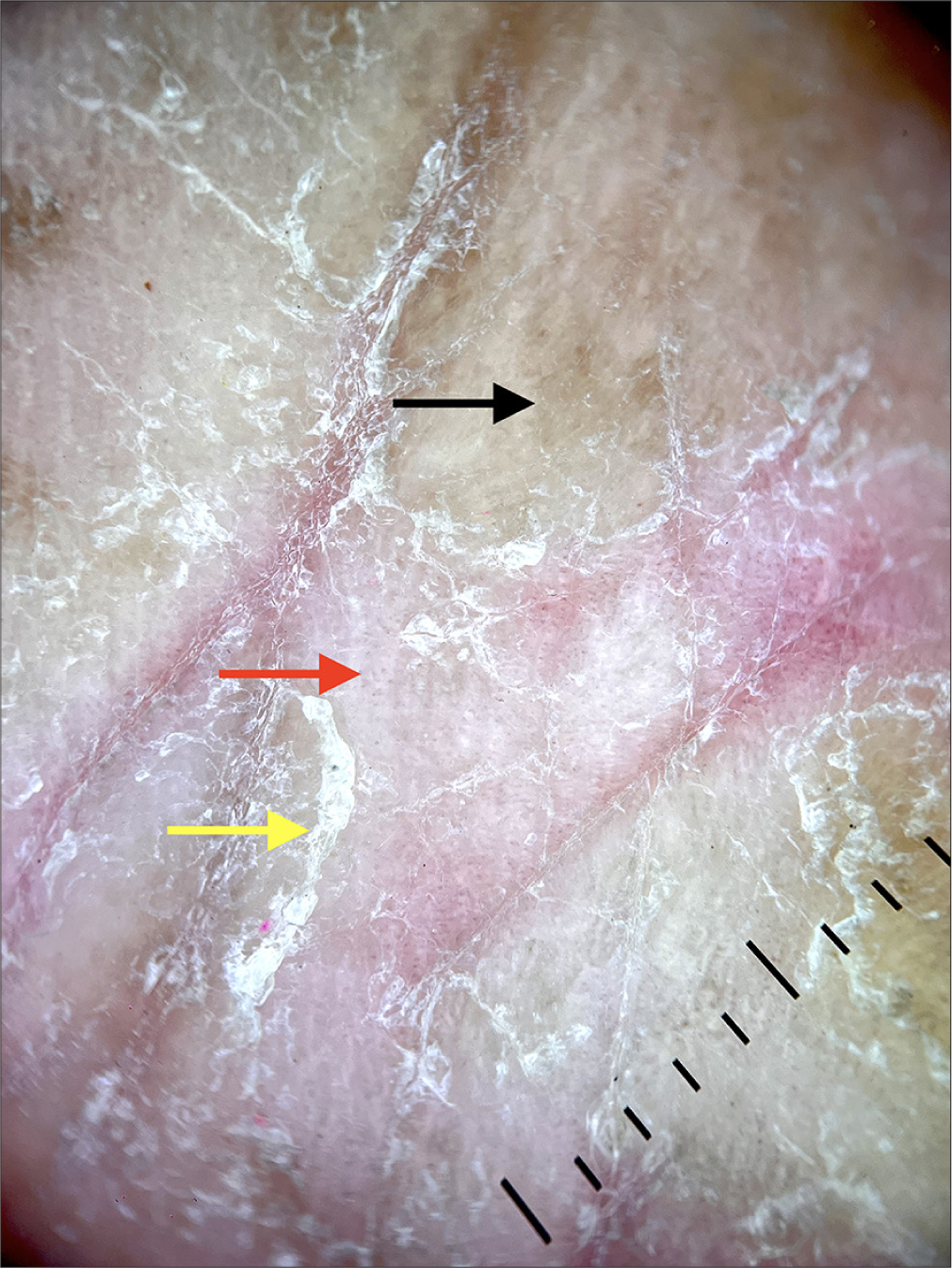 Dermoscopy (DermLite DL4, ×100, polarized light) shows irregular red dots (red arrow), and whitish scales (yellow arrow), with fine peripherally attached scales with a brownish background (black arrow).