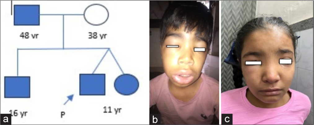 (a) Pedigree of family (b and c) 11-year-old dizygotic twins with hereditary angioedema showing ill-defined swelling over eyelids and lips.