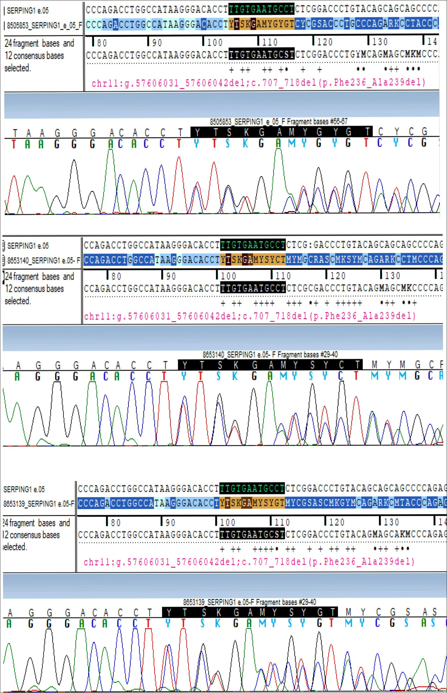 Whole-exome sequencing of the index case and sanger sequencing of the siblings showed a heterozygous 12-base pair deletion in exon 5 of the SERPING1 gene (chr11:g.57606031_57606042del; Depth:101x). IV: Intra venous, FFP: Fresh frozen plasma, SC: Sub cutaneous, C1-INH: C1 esterase inhibitor, FDA: Food and drug administration, HAE: Hereditary angioedema